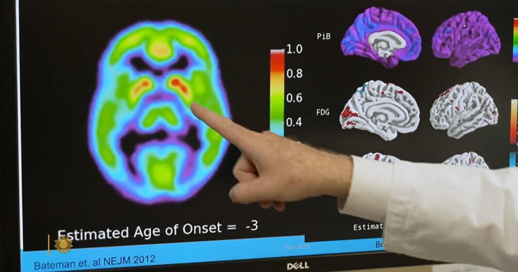 Promising clinical trials in Alzheimer’s prevention